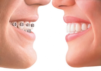 1379513660invisalign-facetoface.jpeg