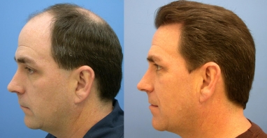1447576584hair-transplant_dr_rana_health_center_aesthetic_riffa_bahrain.jpg