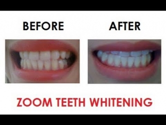 1494169348zoom_4_home_whitening_smile_studio_bahrain.jpg