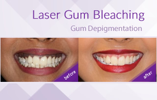 1494169802laser_gum_bleaching_smile_studio_dental_bahrain.jpg